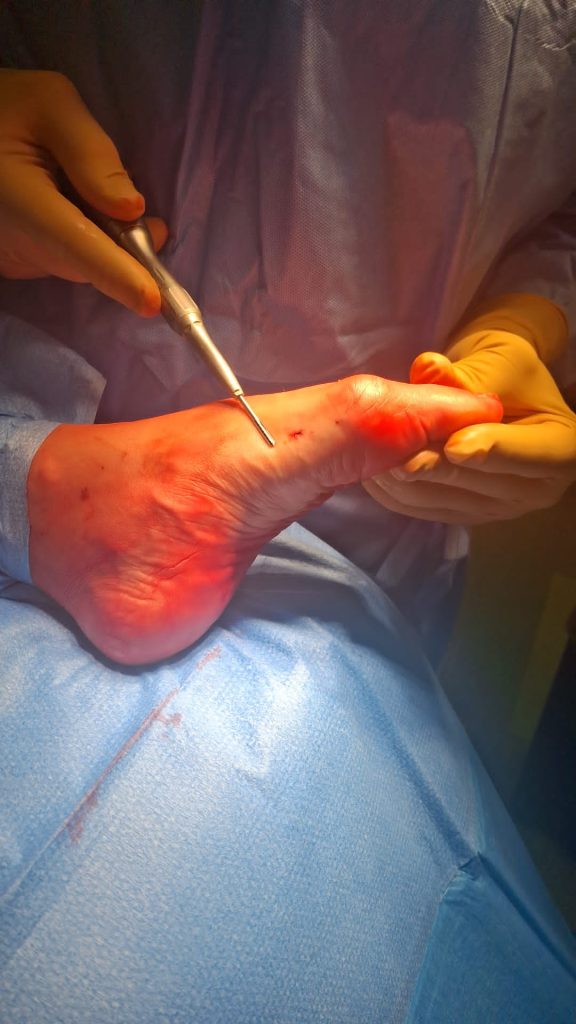 Dettaglio microincisioni chirurgia percutanea piede