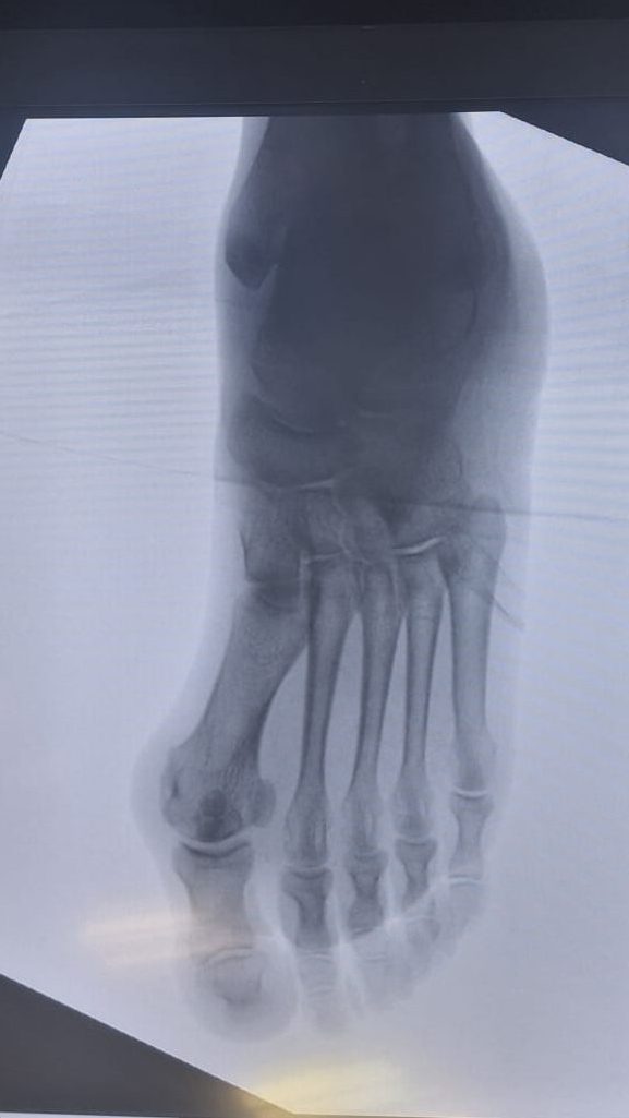 Confronto radiografia e piede con alluce valgo prima dell'intervento