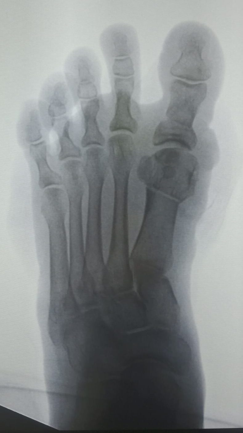 Radiografia di controllo post intervento correzione alluce valgo