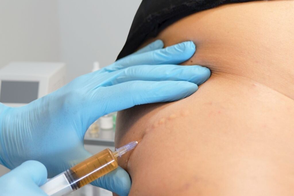 Primavera e Rigenerazione: Perché la Mesoterapia Linfodrenante è il Trattamento Medico che le tue Gambe Aspettavano