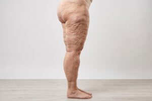 lipedema arti inferiori accumulo adiposo gambe